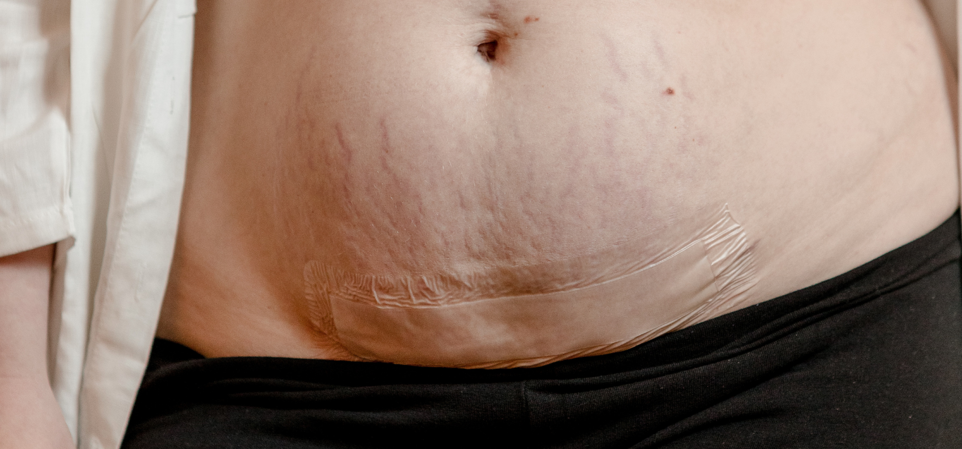 C-Section Scar Care and Treatment Guide