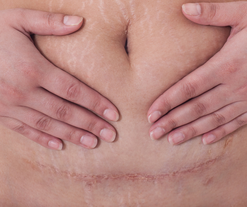 Do This To Your C-Section Scar EVERY DAY To Flatten/Prevent C