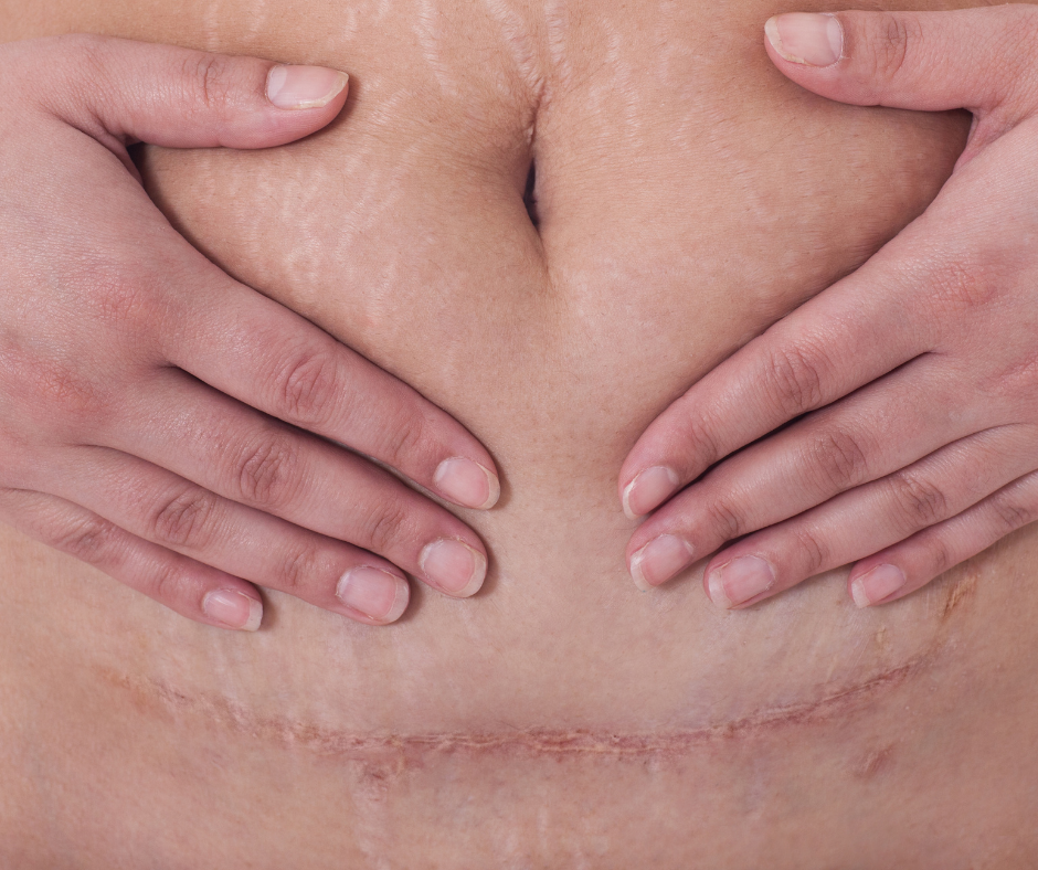 The Untapped Strategy You Need To Stop Your C-Section Scar From