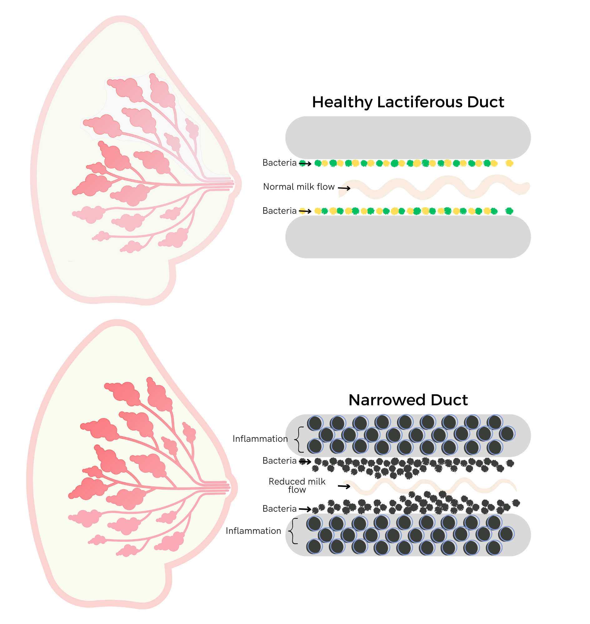 https://aeroflowbreastpumps.com/media/wysiwyg/NEW_Clogged_Duct.png